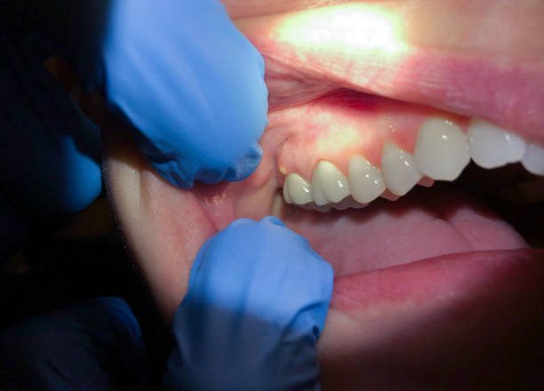 Best Emergency Tooth Extraction  in Blue Island, IL